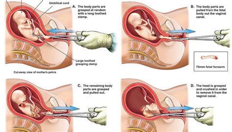 It is an early abortion option. Former abortionist describes horrific dismemberment ...