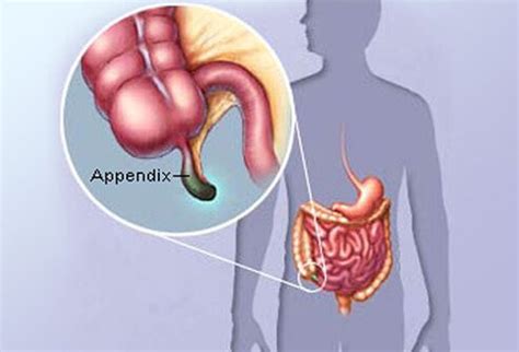 Appendices) is a section at the end of a book or essay containing details that aren't essential to your work, but which could provide useful context or background material. Appendicitis Tests, Treatment, Prevention & Causes