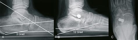 Das längsgewölbe und das vordere quergewölbe des fußes. Orthoforum Flexibler Knicksenkfuß