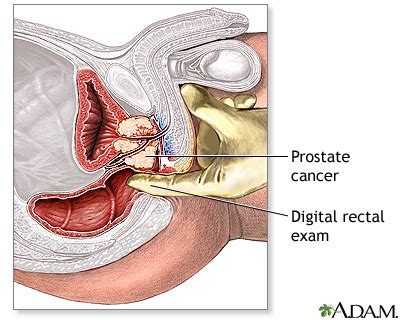 In a properly run court the lawyers might also have to take lie detector tests, and so might juries to confirm that they have not been biased, and that they have fully understood the. Digital rectal exam | UF Health, University of Florida Health