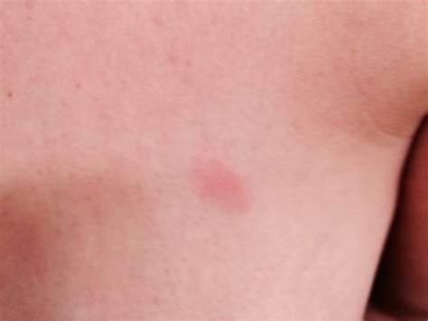 The cancer makes the affected breast red and swallows. Breast Cancer Topic: In panic need advice