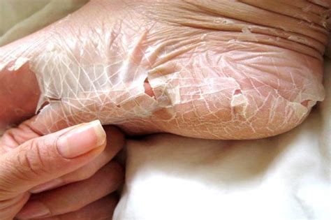 It stores food in its hump. 6 common Cutaneous Conditions that are Serious | Skin ...