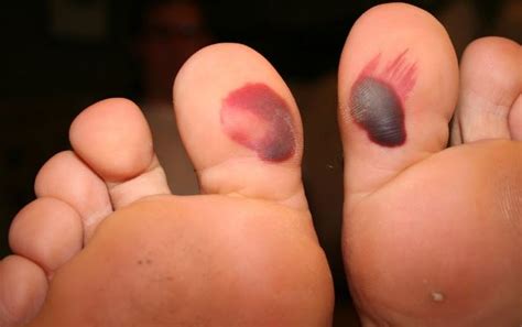 I am going to the cinema tonight. Blood Blister on Toe, Toenail, Causes, Treat, Big, Bottom ...