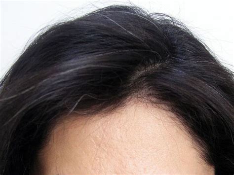 See a hair transplant before and after the treatment is vital to decide to take this step and solve forever your hair loss problems. best female hair transplant - Female Before And After Hair ...