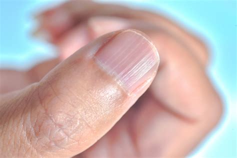 These lines can still simply represent different types of growth, and they're a little more common on people's nails as they age. Have Ridges on Your Fingernails? This is What They ...