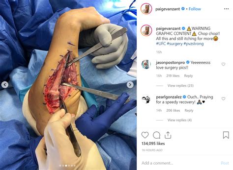 Paige michelle vanzant (née sletten; Paige VanZant Shares Graphic Images Of Arm During And ...