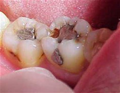 Bakteri di mulut menghasilkan asam yang kemudian berubah menjadi plak. Cara merawat Gigi berlubang, ditambal atau dicabut?