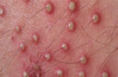 Staph infections, also known as staphylococcus aureus, or staphylococcus infection are a these could be seen in the form of visible boils, infected hair follicles, or bumps looking like cystic you can cure staph infection by using basil leave juice. Folliculitis