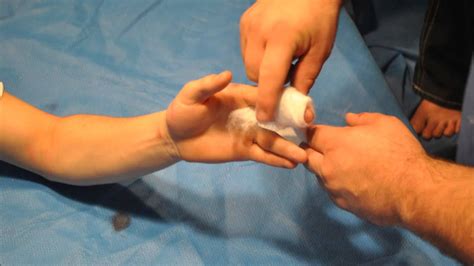 A splint is a rigid or flexible device that maintains in position a displaced or movable part, also used to keep in place and protect an injured radial gutter splint. Radial gutter splint movie - YouTube