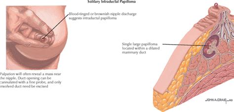 Why do cats wag their tails? What does ductal papilloma feel like, Intraductal ...