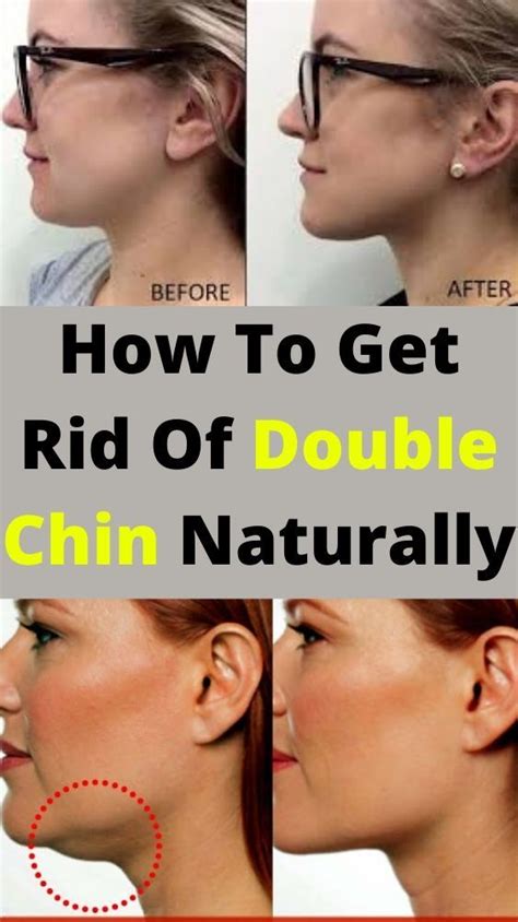 To do this, ultherapy bypasses the surface of the skin through ultrasound energy. How To Get Rid Of Double Chin in 2020 | Double chin, Chin ...