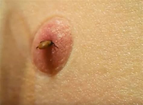 We did not find results for: Skin-crawling moment as tick is EXTRACTED from a person's thigh | Express.co.uk