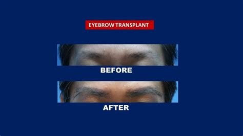 To achieve the most natural result in eyebrow transplant, we operate by paying attention to the millimetric many and horizontal direction. Eyebrow Transplant | Eyebrow Transplant | Affordable and ...