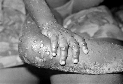 Symptoms begin with fever, headache, muscle pains, swollen lymph nodes, and feeling tired. Monkeypox