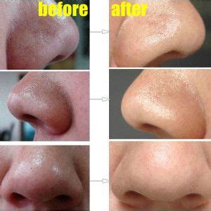 But you can control and reverse these effects with the help of some simple diy home remedies, preventive. How To Easily Remove Deep Blackheads from Nose