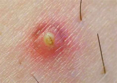 What does an ingrown hair look like? Ingrown Hair on Thigh - Pictures, Causes and Treatment