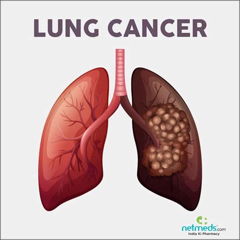 Symptoms of lung cancer typically become more pronounced as the disease grows, often progressing from a minor cough to something more severe. How to Spot Lung Cancer Symptoms - Healthful UK