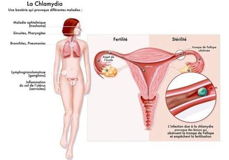 C'est l'intrusion ou le mouvement d'un tissu endometrial qui affecte le muscle de l'utérus. IST : la HAS recommande un dépistage systématique de l ...
