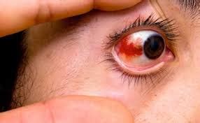 7 cara mudah merawat mata agar tetap sehat dan jernih. Cara menghilangkan titik merah di putih mata - Green World ...