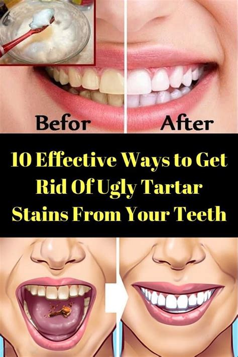 The dental industry has created various tooth whitening systems that help keep your knowing you can prevent your teeth from being stained should encourage you to floss more often. Are you suffering from tartar stains on your teeth and ...