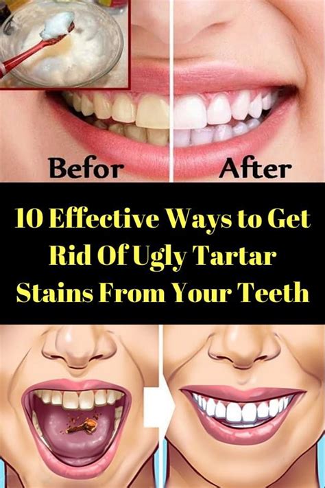 For example, the acidity in lemons could cause worse damage by drastically weakening your tooth enamel. Are you suffering from tartar stains on your teeth and ...