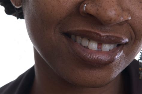 By design, a rubber band is meant to. Close Gaps in Teeth with One of These Orthodontic ...