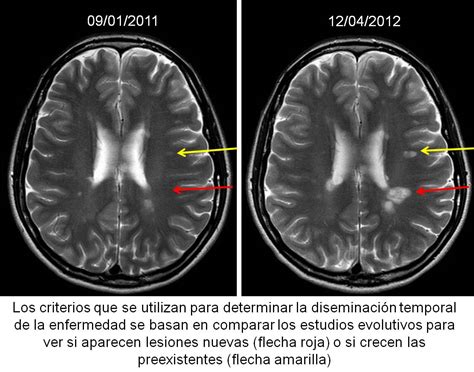 Paciente de 45 años con un cuadro clínico que comenzó hace 2 años con ligera disminución de la fuerza muscular, debilidad e inestabilidad para la marcha, tuvo una evolución desfavorable y en la. EPOS™ - S-0376