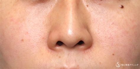【30代女性・鼻の穴を目立たせない】鼻孔縁下降術（術後1週間 ...