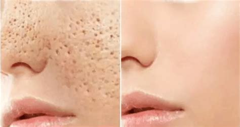 How did they get so big? 3 DAYS AND ALL OPEN PORES WILL DISAPPEAR FROM YOUR SKIN ...