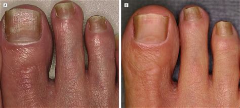 One way of treating toenail fungus is vicks® vaporub®. Vicks Vapor Rub Nail Fungus Inspirational 20 Surprising ...