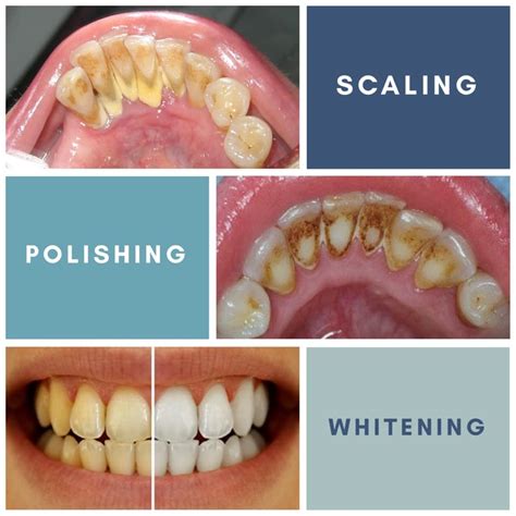 Satu lagi perbezaan penting antara klinik dan hospital ialah klinik biasanya tidak mempunyai katil yang dimaksudkan untuk pesakit. Ini Perbezaan Antara Scaling, Polishing Dan Whitening ...