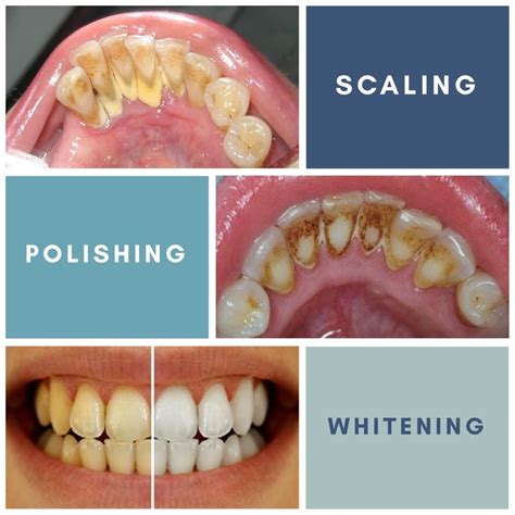 Sebagai kata benda perbezaan antara klinik dan poliklinik. Ini Perbezaan Antara Scaling, Polishing Dan Whitening ...