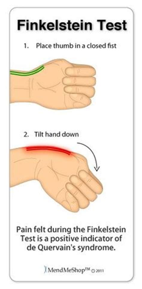 A test for diagnosing de quervain's tenosynovitis, or snapping thumb syndrome. Die 36 besten Bilder von Eiskaltes Händchen | Ergotherapie ...