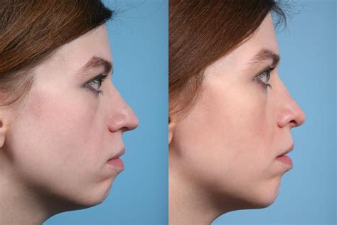 So be careful 😁 #ihsg tlkm #idx Rhinoplasty by Dr. Mustoe Before & After Photos Patient 1 ...