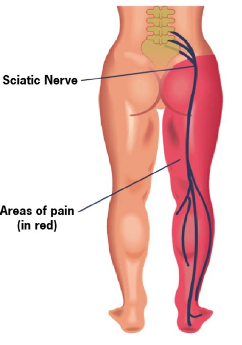 Read about sciatica, which is pain caused by irritation or compression of the sciatic nerve. Sciatica Pain: Treatment Tips And Overlooked Remedies