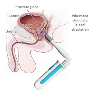 You have to take note of cleanliness, relaxation, and lubrication. sonic prostate massager diagram - Best Prostate Massager Guide