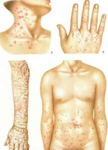 Come riconoscere la scabbia? I primi sintomi
