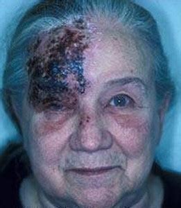 Oral herpes involves the face or mouth. Shingles Newnan | Herpes Zoster Peachtree City | Elderly ...