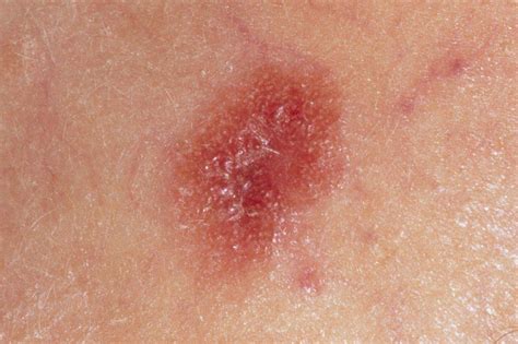 In the treatment of early melanoma, surgical intervention is. Skin Cancer: Causes, Symptoms, Treatment, and Prevention