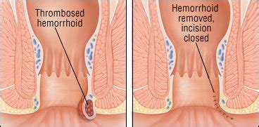 Most recent weekly top monthly top most viewed top rated longest shortest. Hemorrhoids Guide: Causes, Symptoms and Treatment Options
