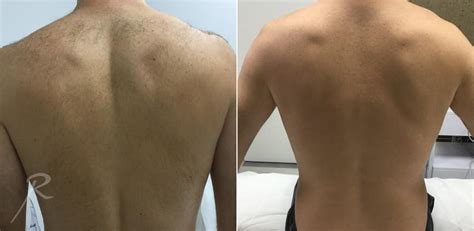 There's not really any other permanent back hair removal options. Dad Make-Over Treatments In New York City — Russak+ ...