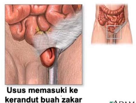 * orang memiliki saka sukar untuk mendapat anak. Rawatan Islam Bekam Ruqyah Sihir Saka Santau Meru, Klang ...