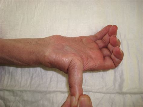 ¿qué causa dolor en las articulaciones? La hiperlaxitud ligamentosa causa de dolor en las manos de ...