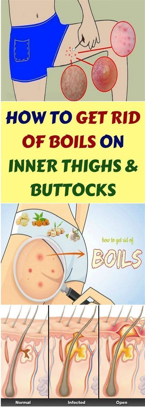 A boil (also called a furuncle) is a common type of infection that occurs in a hair follicle. Remedies to Get Rid of Boils on Inner Thighs | Get rid of ...