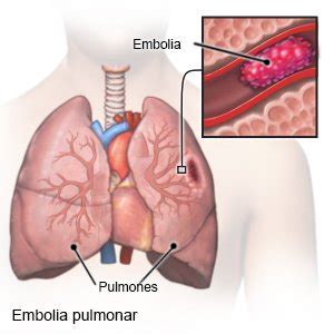 La trombosis (enfermedad trombótica) es un trastorno que implica la formación de trombos o coágulos en el sistema circulatorio. Embolia Pulmonar Care Guide Information En Espanol