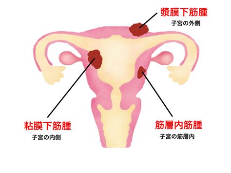 Nahrávejte, sdílejte a stahujte zdarma. 子宮 筋腫 | 子宮筋腫