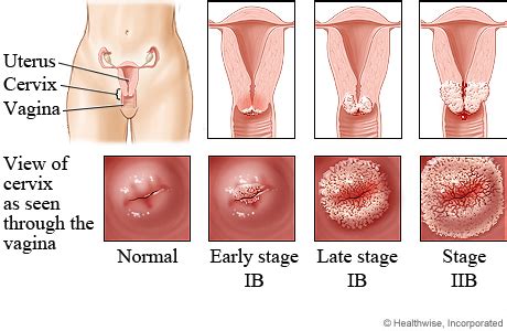 Medically reviewed by melinda ratini, do, ms on may 15, 2020. Avail Beauty: Cervical Cancer