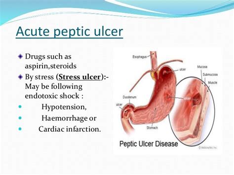 Curlings ulcer in the largest biology dictionary online. Why are you called stress ulcer? | Ulcers, Peptic ulcer ...