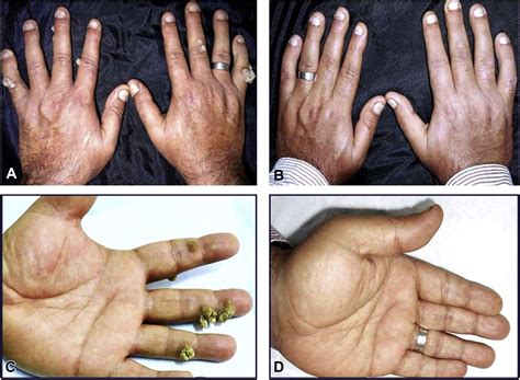 For patients with recalcitrant warts, combination therapy with acitretin and intralesional candida antigen is superior to either acitretin or candida antigen alone, according to a study published in the. References in Intralesional versus intramuscular bivalent ...
