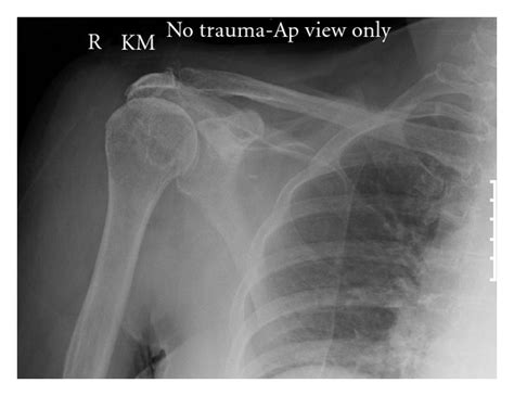 Patients with muscle tenderness are diagnosed with myofascial pain. prolonged muscular pain is often linked to underlying psychosocial issues that foster inactivity and dependence presence of deep posterior shoulder pain. Anterior-posterior radiograph of the right shoulder at ...